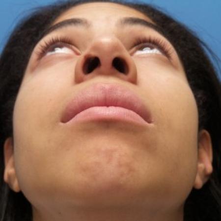 After image 3 Case #86446 - Rhinoplasty - 3 months post-op