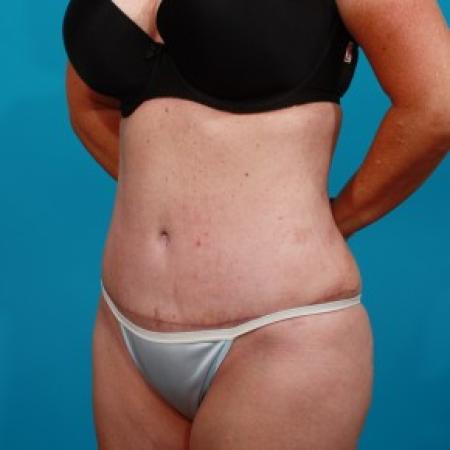 After image 2 Case #84101 - Abdominoplasty with Flank Lipo