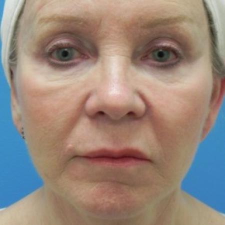 After image 1 Case #86616 - Facelift/Upper & Lower Blepharoplasty/Laser Resurfacing to Full Face/Juvederm      7 months post-op