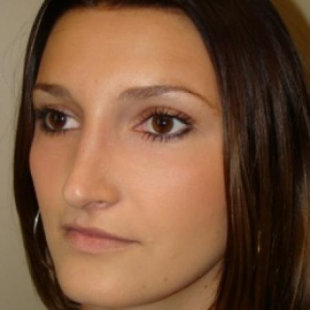 After image 5 Case #79961 - Open Rhinoplasty