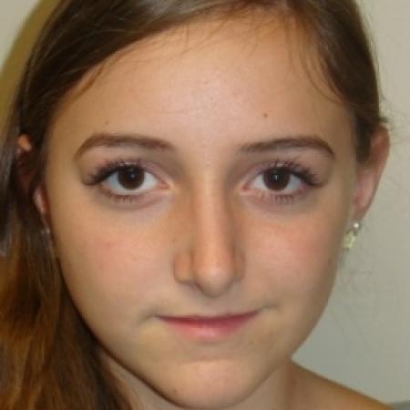 After image 1 Case #80406 - Open Rhinoplasty