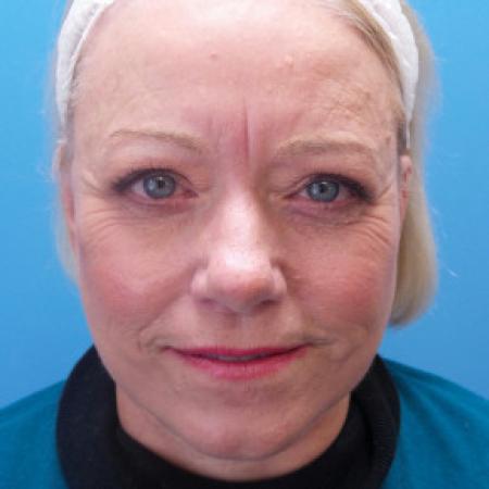After image 1 Case #88146 - 66 year old - Facelift/Upper & Lower Blepharoplasty/Skin Resurfacing - 4 months post-op