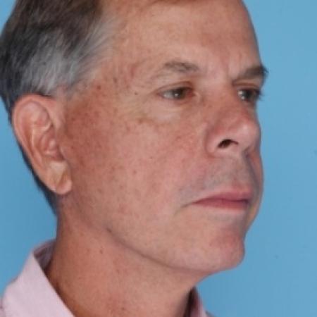After image 2 Case #79686 - Facelift