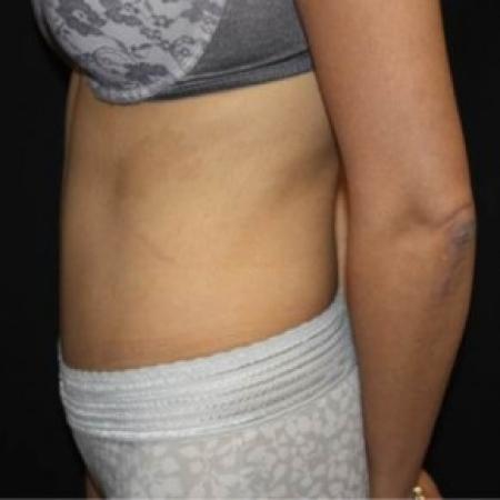 After image 3 Case #85021 - Abdominoplasty - 39 year old female