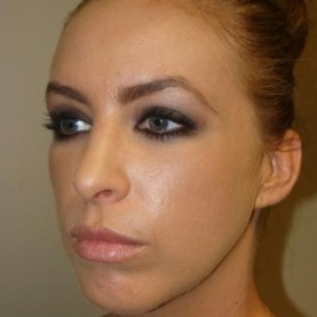 After image 5 Case #80476 - Open Rhinoplasty