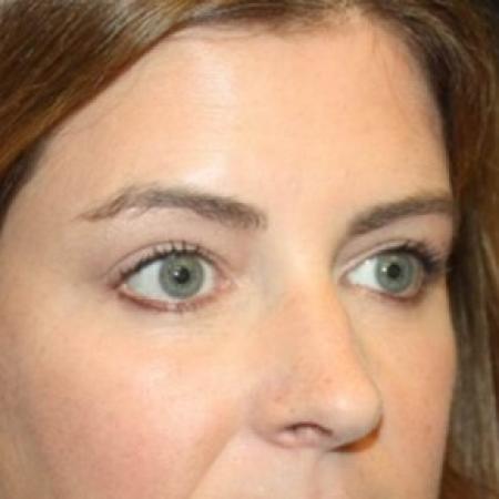 After image 2 Case #85171 - Blepharoplasty and Browlift - 45 year old female