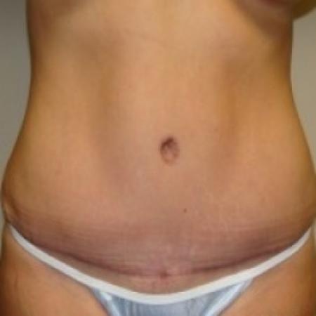 After image 1 Case #79491 - Tummy Tuck
