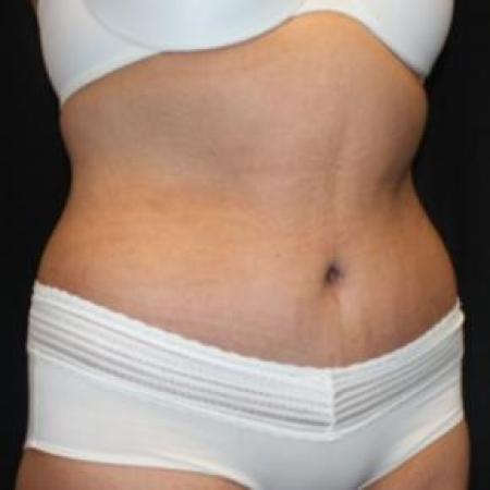 After image 2 Case #85866 - Total Body Lift - 57 year old female