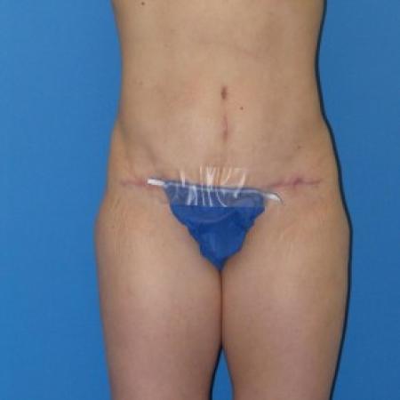 After image 1 Case #84556 - Abdominoplasty