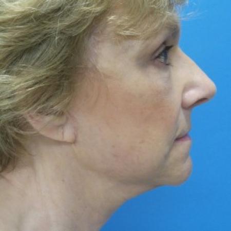 After image 3 Case #86556 - Facelift/Upper & Lower Blepharoplasty/Laser Resurfacing to Full Face     5 months post-op