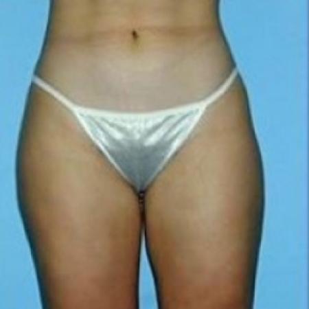 After image 1 Case #79176 - Liposuction