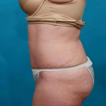 After image 3 Case #83946 - Abdominoplasty with Flank Lipo