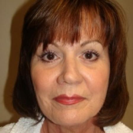 After image 1 Case #79621 - Blepharoplasty