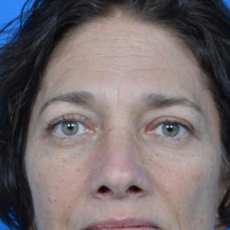After image 1 Case #87896 - Upper Eyelid Surgery (blepharoplasty)