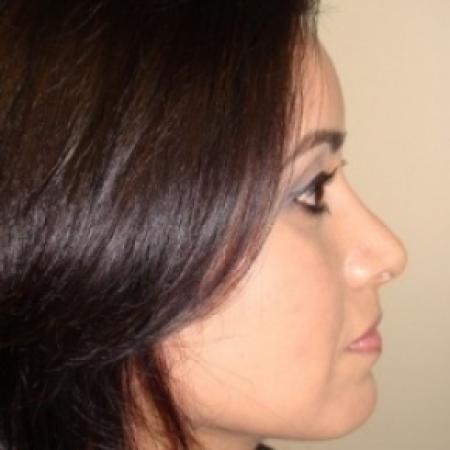 After image 5 Case #79041 - Rhinoplasty