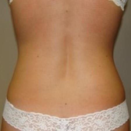 After image 4 Case #79031 - Liposuction