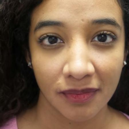 After image 1 Case #86471 - Rhinoplasty/Septoplasty/Turbinectomy - 1 year post-op