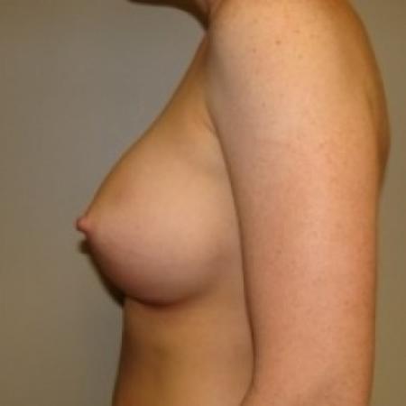 After image 3 Case #79386 - Breast Augmentation