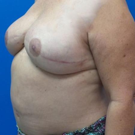 After image 2 Case #87326 - Breast Reconstruction Revision