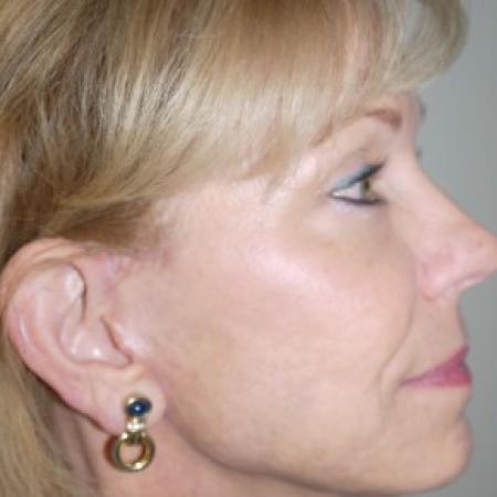 After image 3 Case #82441 - 56 year old with facial wrinkles, history of acne scarring