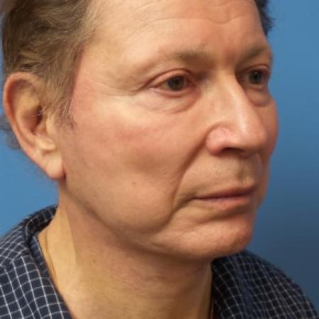 After image 2 Case #86571 - Facelift/Chin Augmentation with Implant     7 months post-op
