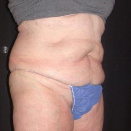 After image 5 Case #81861 - CoolSculpting