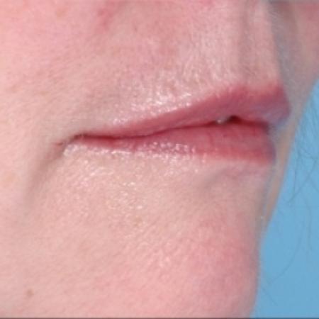 After image 2 Case #79286 - Injectables