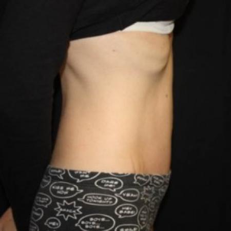 After image 3 Case #84861 - Abdominoplasty - 42 year old female