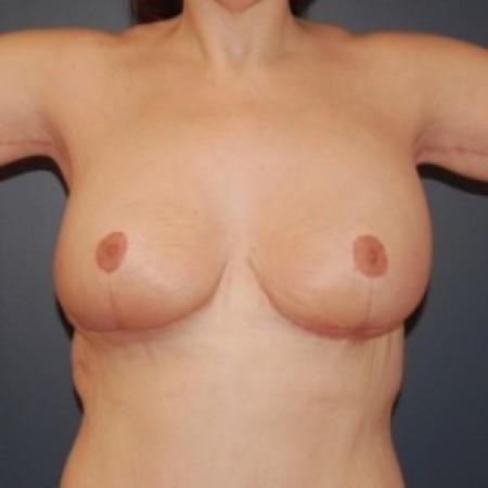 After image 1 Case #81271 - Bilateral Breast lift and arm lift
