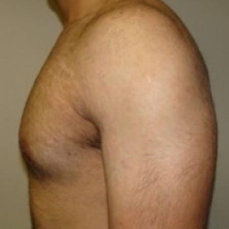 After image 3 Case #79046 - Gynecomastia