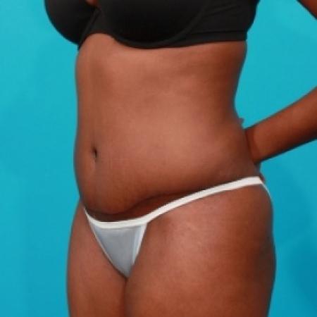 After image 2 Case #78896 - Tummy Tuck