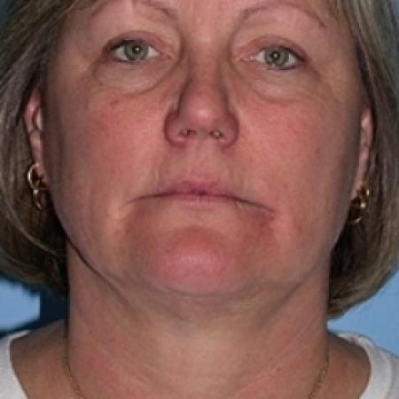 After image 1 Case #79216 - Liposuction