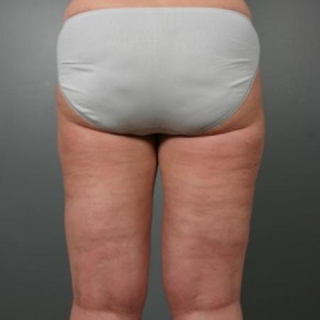 After image 2 Case #83586 - Liposuction Thighs