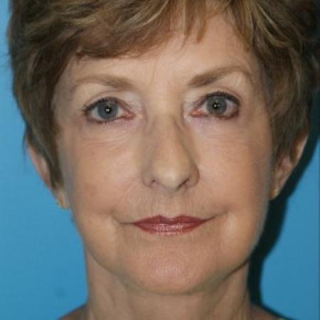 After image 1 Case #86621 - Facelift/Liposuction of the Neck/Laser Resurfacing to Full Face     3 months post-op