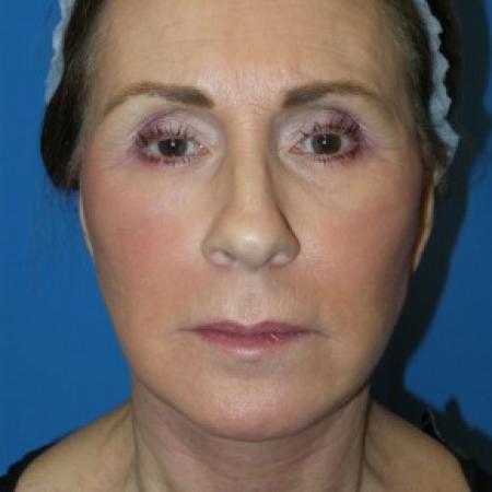 After image 1 Case #86576 - Facelift/Laser Resurfacing to Full Face     1 month post-op