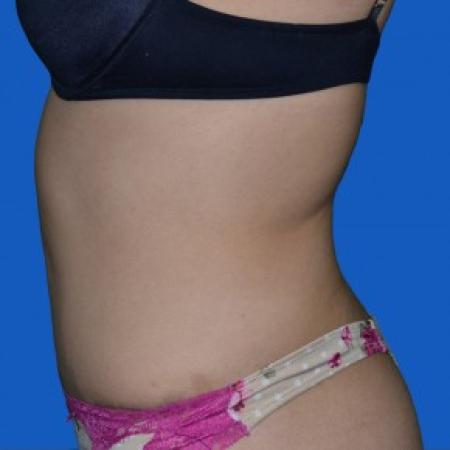 After image 2 Case #87851 - Tummy Tuck