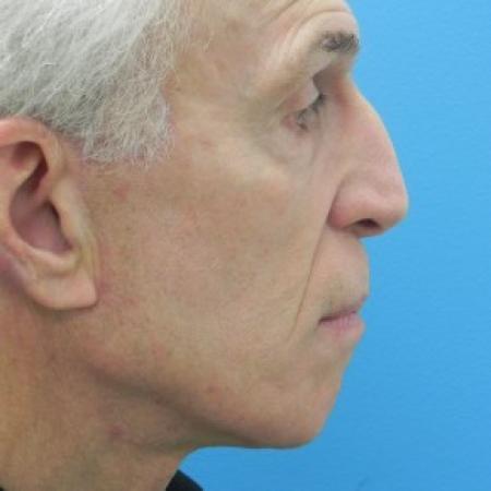 After image 1 Case #86696 - Facelift - 2 months post-op