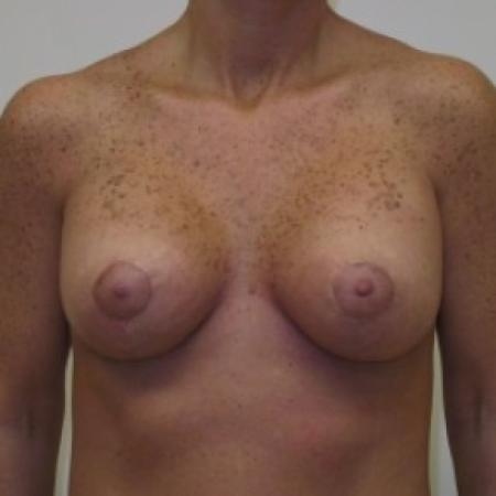 After image 1 Case #81116 - Breast Lift with Saline Filled Implants