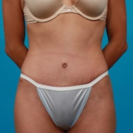 After image 1 Case #78906 - Tummy Tuck