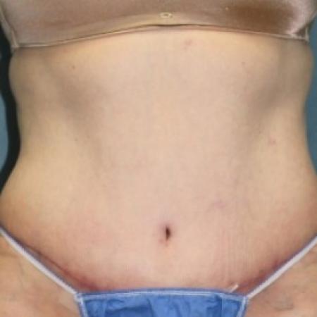 After image 1 Case #81071 - Abdominoplasty