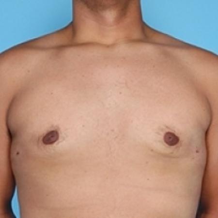After image 1 Case #79271 - Male Breast Reduction