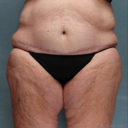 After image 1 Case #86821 - After Weight Loss Body Contouring Panniculectomy