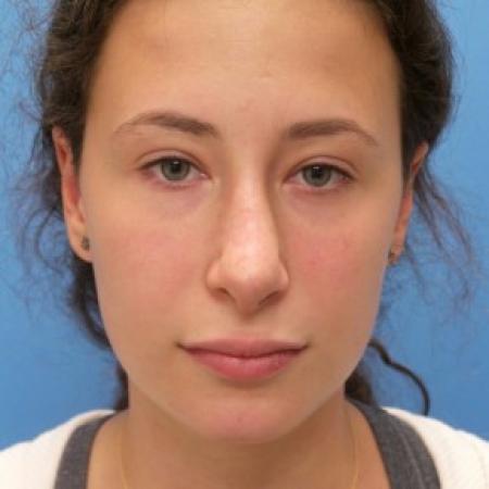 After image 1 Case #86456 - Rhinoplasty - 3 months post-op
