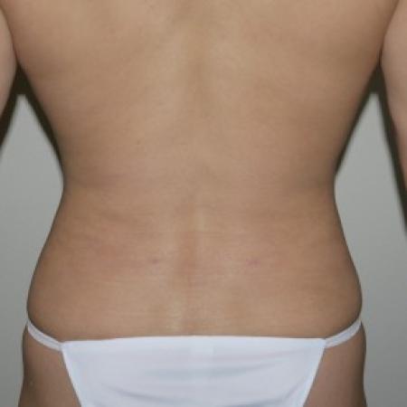 After image 3 Case #82561 - Liposuction of the abdomen and hips