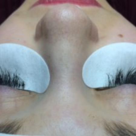 After Case #86396 - 26 year old woman treated with eyelash enhancement