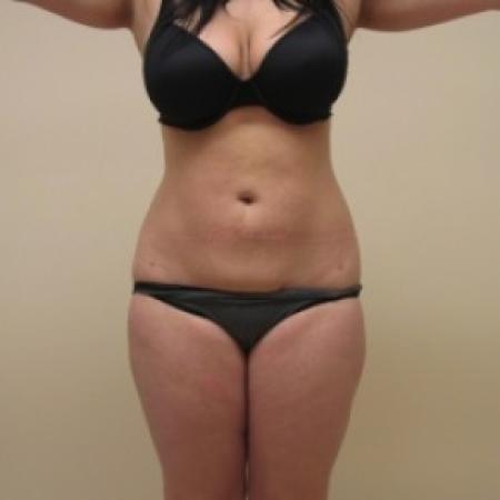 After image 1 Case #81156 - Liposuction