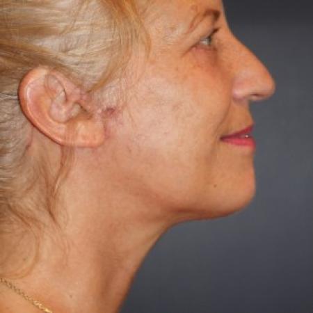 After image 2 Case #86251 - Balanced face after facelift