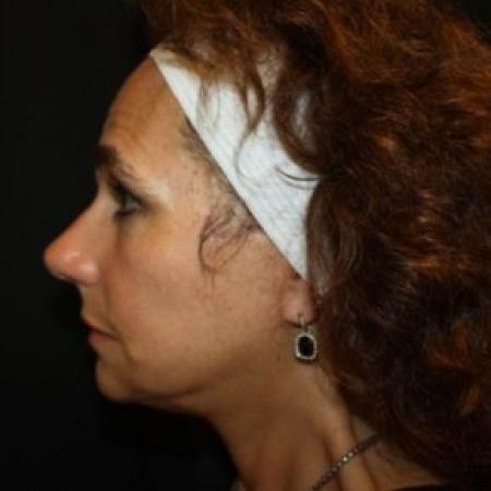 After image 3 Case #85061 - Facelift and Neck Lift - 58 year old female