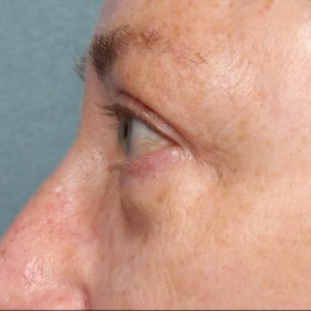 After image 2 Case #86771 - Upper Blepharoplasty ( Eyelid Lift )