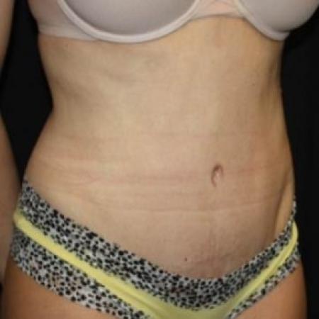 After image 2 Case #84221 - Abdominoplasty, plication of rectus diastasis, ventral hernia repair - 35 year old female